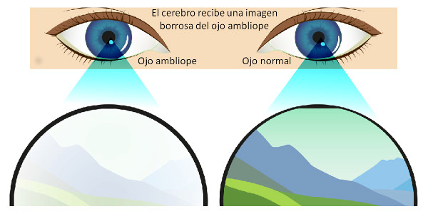 Imagen ¿Qué es el ojo vago o ambliopía? Síntomas, causas y tratamiento de la ambliopía | Asociación Española de Optometristas Unidos