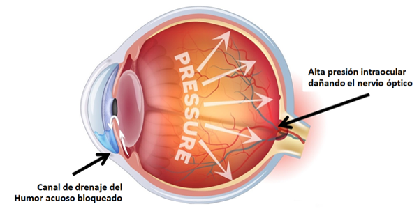 Imagen El glaucoma, la enfermedad silenciosa: ¿qué es el glaucoma, sus síntomas, su prevención y control? | Asociación Española de Optometristas Unidos