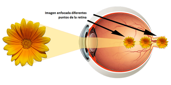 Imagen El astigmatismo: ¿qué es, tipos de astigmatismo, tratamiento y compensación? | Asociación Española de Optometristas Unidos
