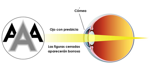 Imagen Presbicia o vista cansada: ¿qué es la presbicia, síntomas, causas y tratamiento? | Asociación Española de Optometristas Unidos