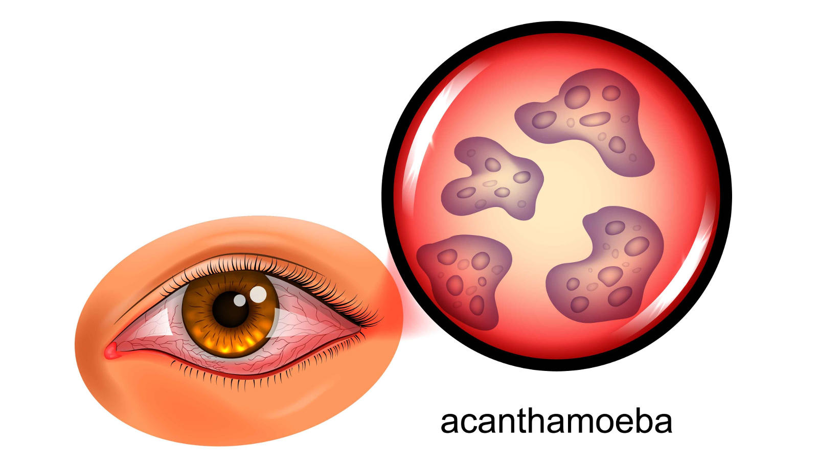 Imagen causas de la queratitis de la Asociación Española de Optometristas Unidos