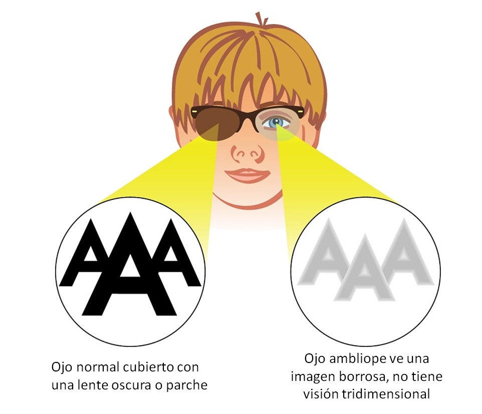 Imagen ojo vago o ambliopía de la Asociación Española de Optometristas Unidos