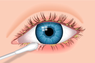Imagen prevención de la blefaritis de la Asociación Española de Optometristas Unidos