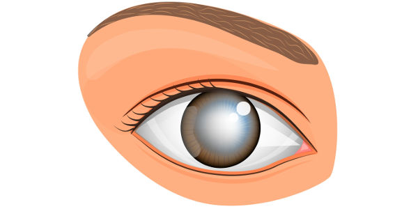 Imagen Cataratas: qué son, causas, tipos, diagnóstico, tratamiento y operación | Asociación Española de Optometristas Unidos