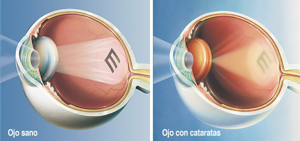 Imagen Causas de las cataratas de la Asociación Española de Optometristas Unidos