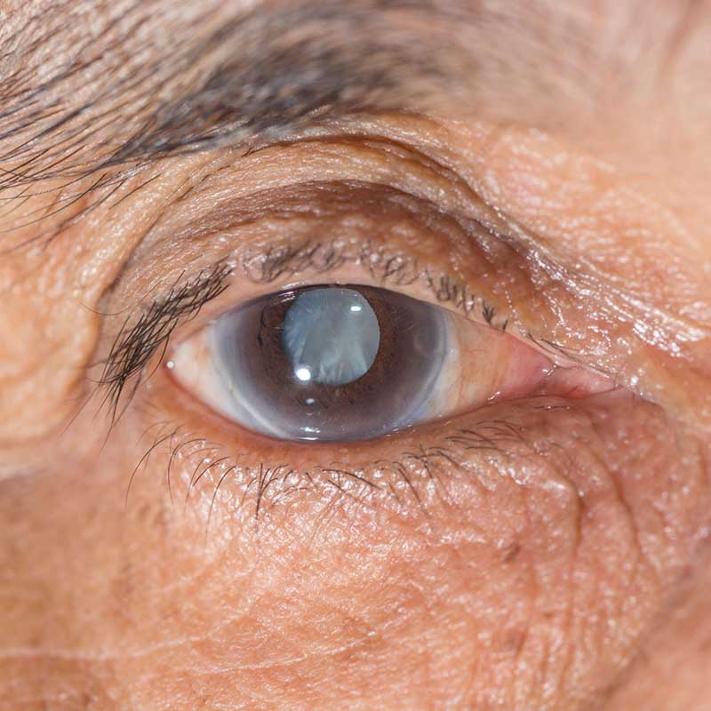 Imagen modelo con cataratas oculares de la Asociación Española de Optometristas Unidos