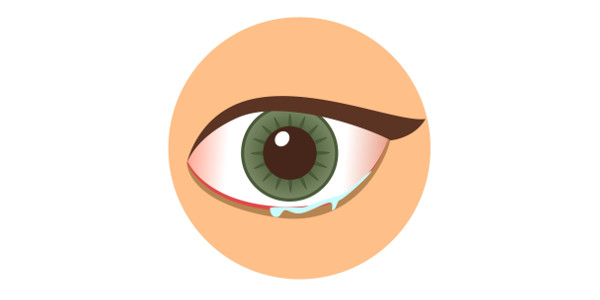 Imagen Conjuntivitis: qué es la conjuntivitis, síntomas, causas, tratamiento y prevención | Asociación Española de Optometristas Unidos
