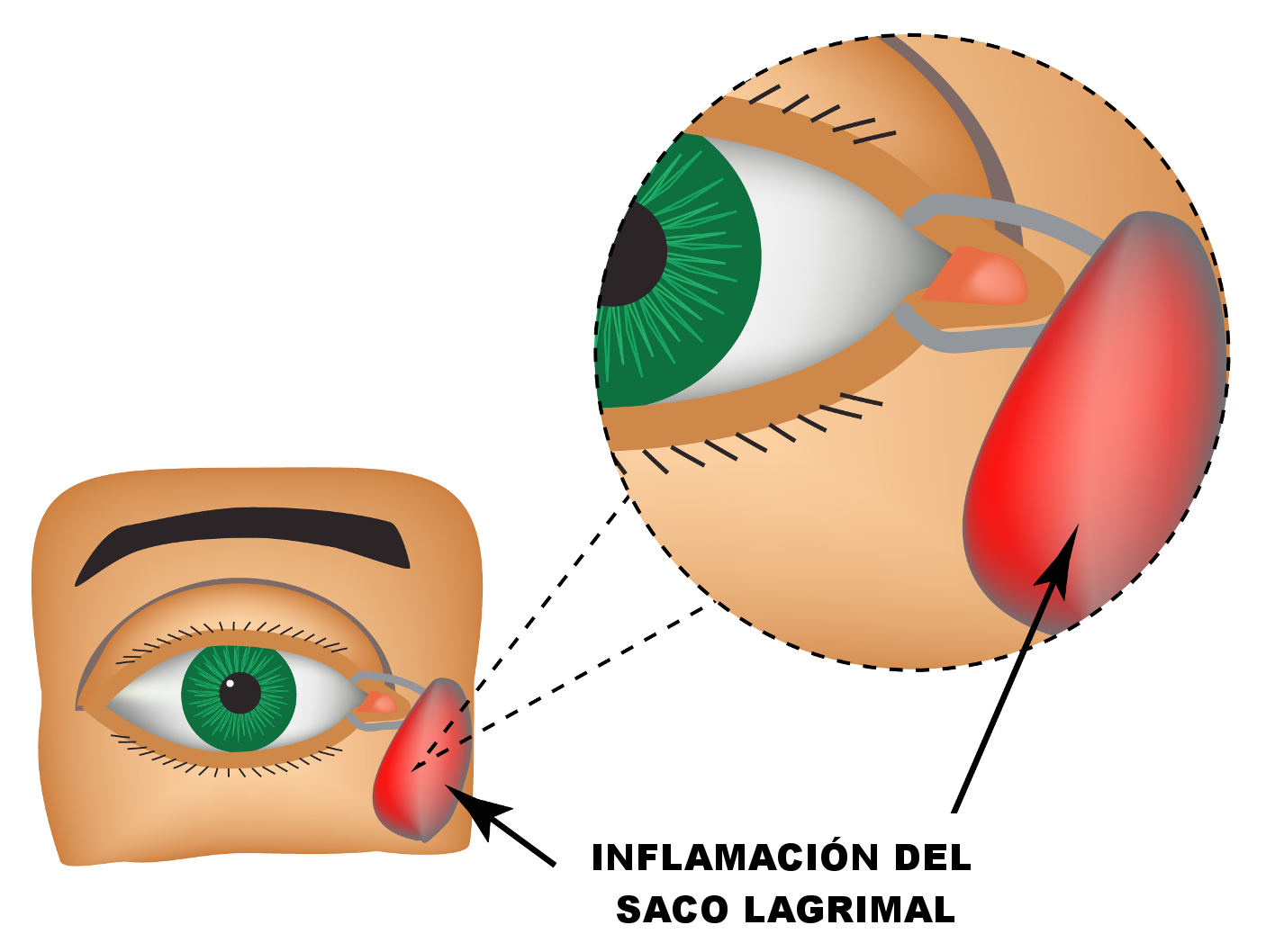 Imagen Dacriocistitis causas. Asociación Española de Optometristas Unidos