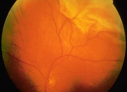 Imagen ojo causante del desprendimiento de retina de la Asociación Española de Optometristas Unidos