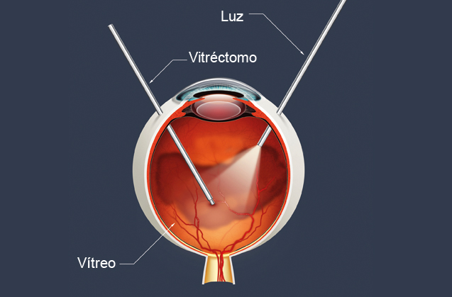 Imagen Vitrectomía desprendimiento de retina de la Asociación Española de Optometristas Unidos