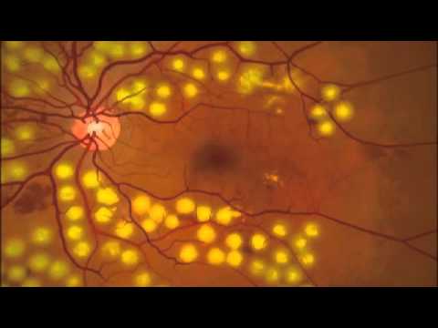Imagen cirugía con láser (fotocoagulación) desprendimiento de retina de la Asociación Española de Optometristas Unidos