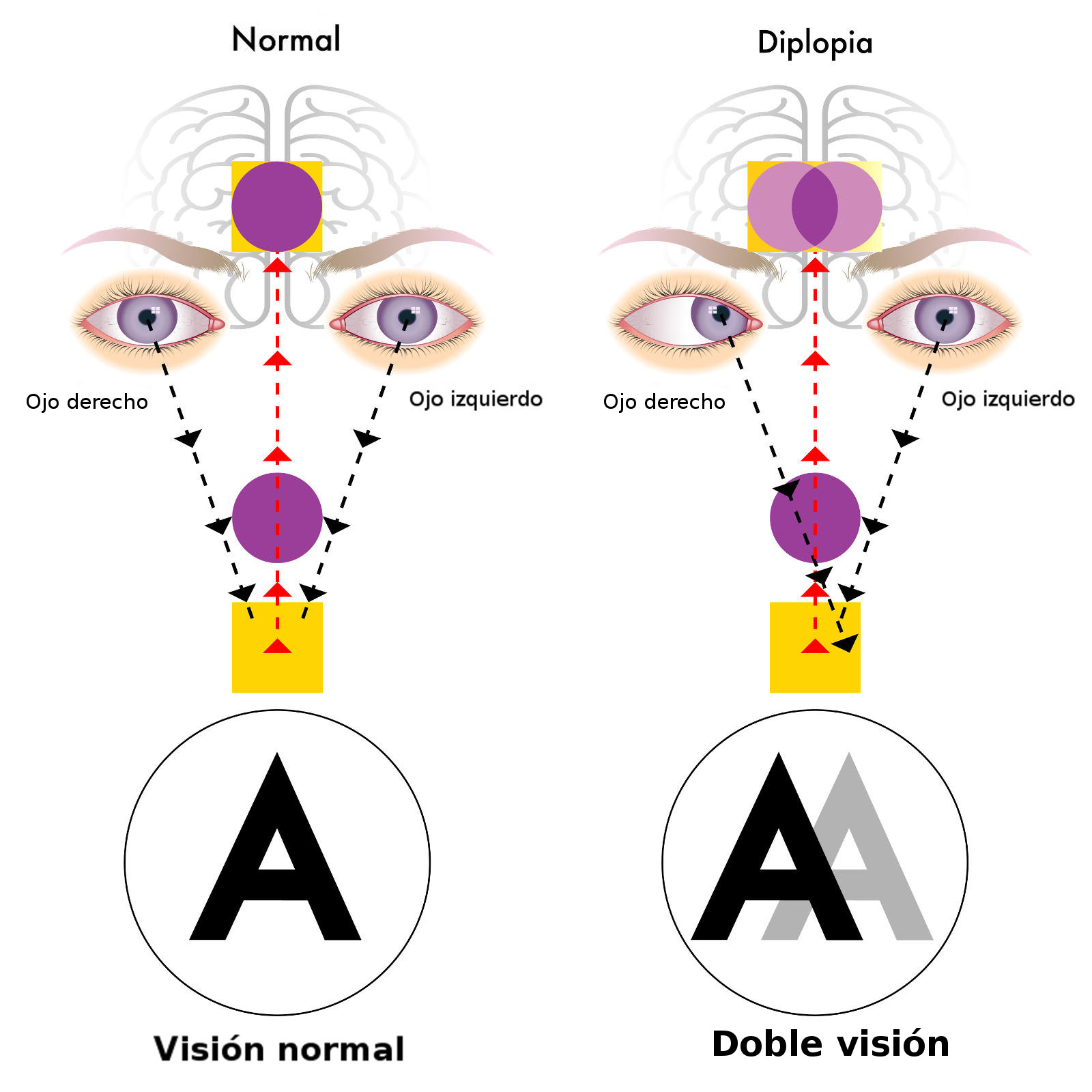 Левый глаз темнее правого. Двоение в глазах. Диплопия. Нарушение зрения диплопия. Двоение в глазах диплопия.