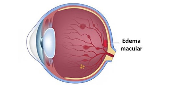 Imagen Edema macular: qué es, síntomas, causas, prevención y tratamiento | Asociación Española de Optometristas Unidos
