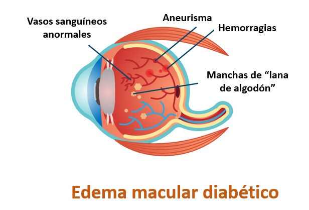 Imagen causas del edema macular de la Asociación Española de Optometristas Unidos
