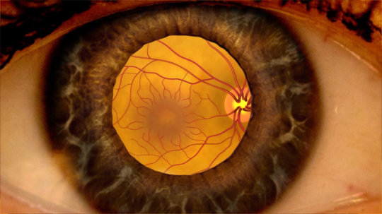 Imagen que és el edema macular de la Asociación Española de Optometristas Unidos