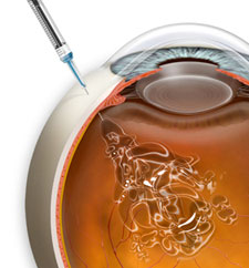 Imagen tratamiento del edema macular de la Asociación Española de Optometristas Unidos