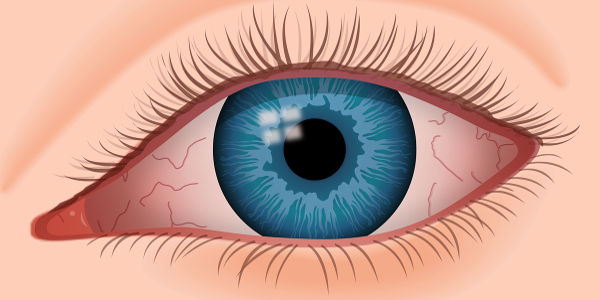 Imagen Ojo seco o síndrome del ojo seco: síntomas, causas, prevención, tratamiento y operación | Asociación Española de Optometristas Unidos