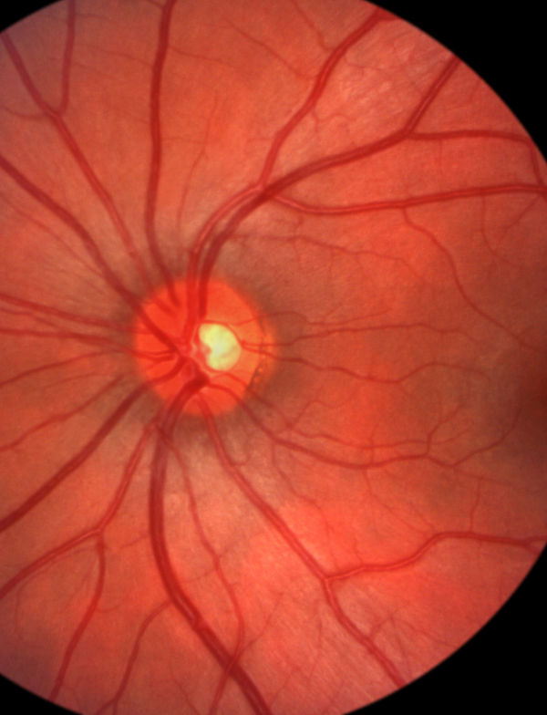 Imagen Patología ocular Asociación de Optometristas Unidos