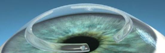 Imagen Tratamiento del queratocono en la Asociación Española de Optometristas Unidos