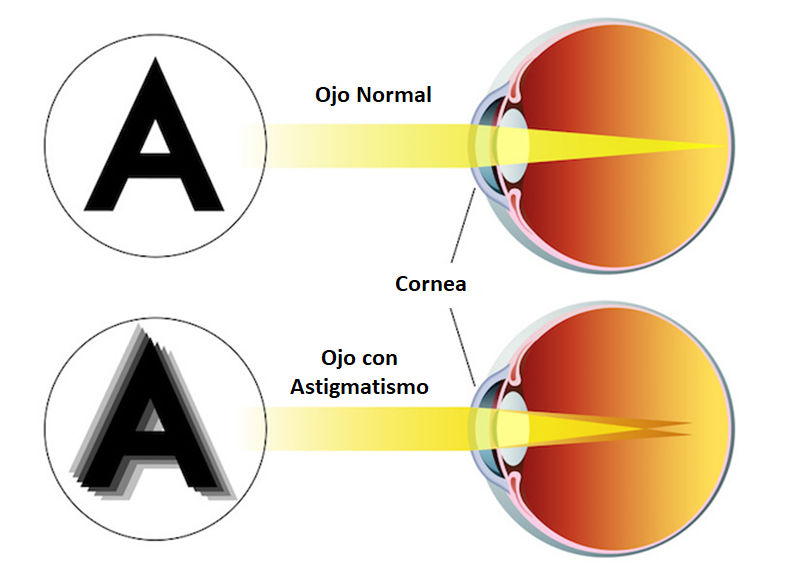 Tipos de astigmatismo, según su existencia. Asociación Española de Optometristas Unidos