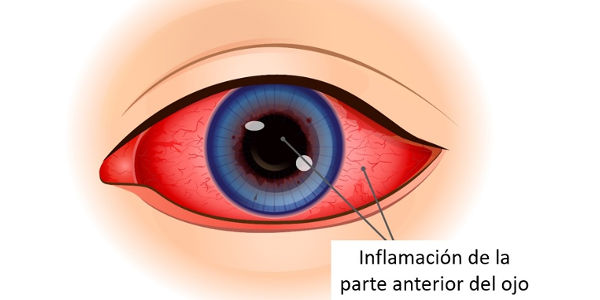 Imagen Uveítis: qué es, síntomas, causas, diagnóstico y tratamiento | Asociación Española de Optometristas Unidos