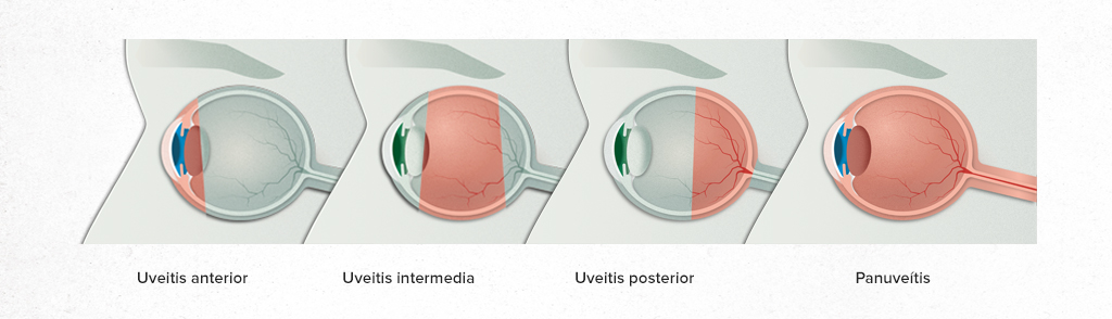 Imagen causas de la uveítis de la Asociación Española de Optometristas Unidos