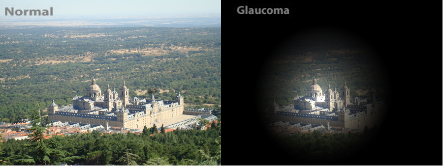 Imagen de la visión normal y visión con glaucoma de la Asociación Española de Optometristas Unidos